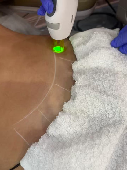 Laser Hair Removal